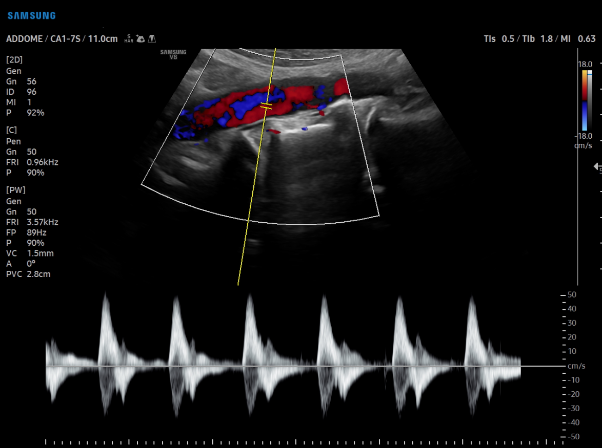 Eco Color Doppler Cedir
