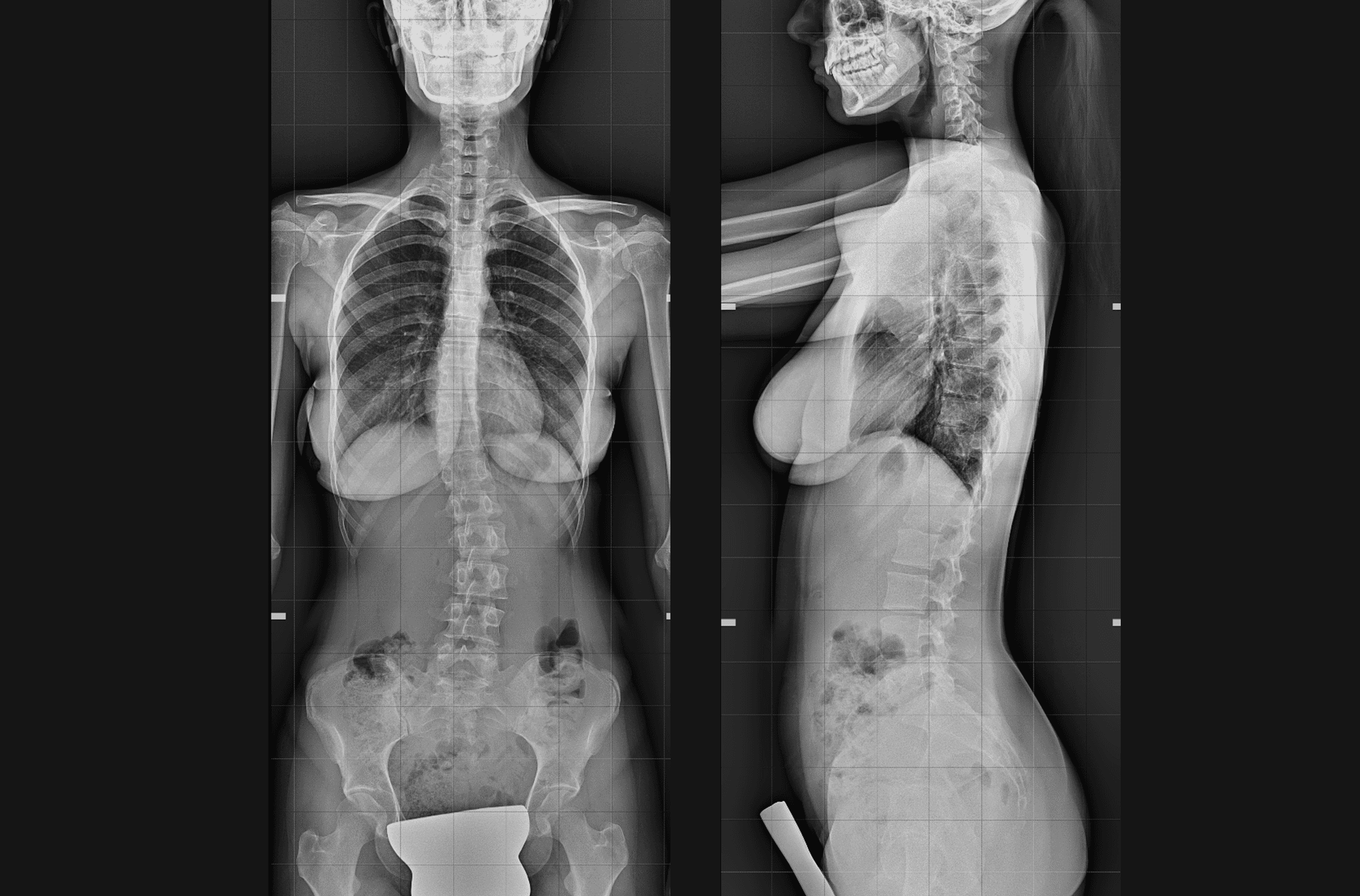 Studio radiografico del rachide